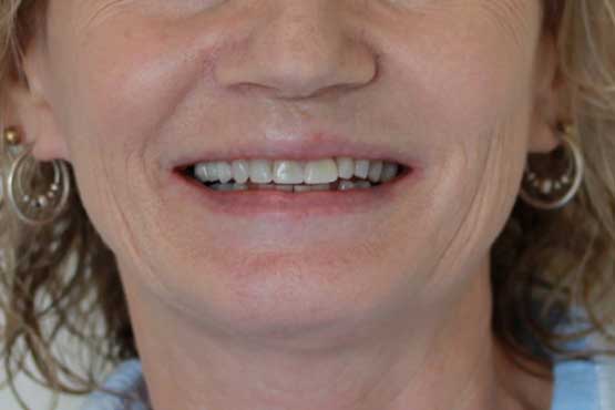 Smile Makeover Gallery 33 Natural-(-2-shades-lighter)B