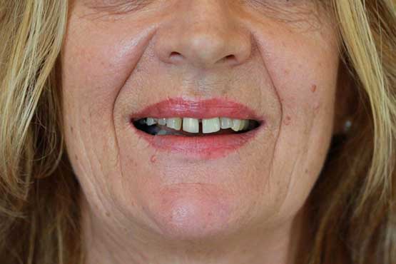 Smile Makeover Gallery 31 Natural-(-2-shades-lighter)B1