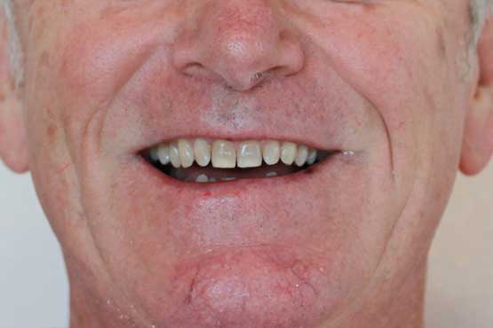 Smile Makeover Gallery 35 Natural-(-2-shades-lighter)B2