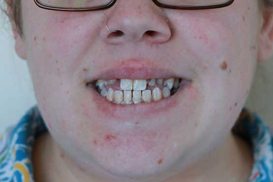 Smile Makeover Gallery 37 Natural-(-2-shades-lighter)B3