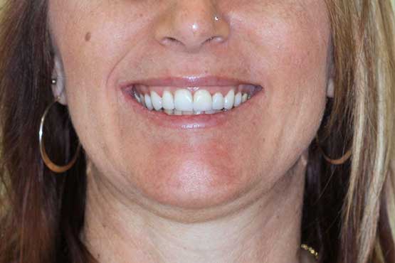 Smile Makeover Gallery 18 Natural-(-3-shades-lighter)A1