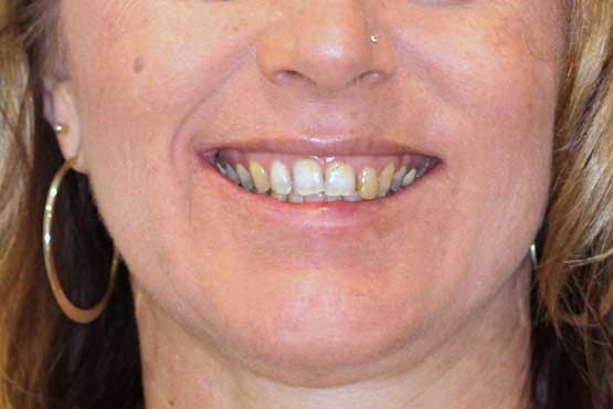 Smile Makeover Gallery 17 Natural-(-3-shades-lighter)B1