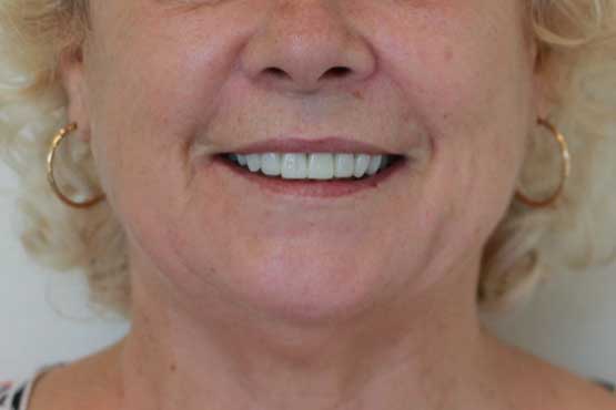Smile Makeover Gallery 30 Natural-(-4-shades-lighter)A