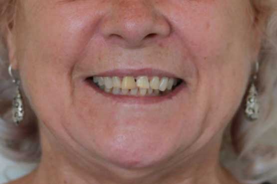 Smile Makeover Gallery 29 Natural-(-4-shades-lighter)B