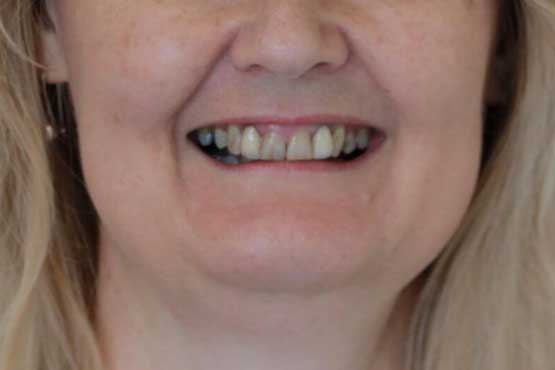 Smile Makeover Gallery 15 Natural-(-5-shades-lighter)