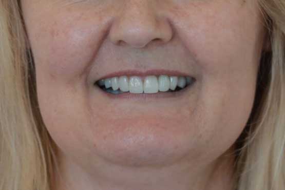 Smile Makeover Gallery 16 Natural-(-5-shades-lighter)after