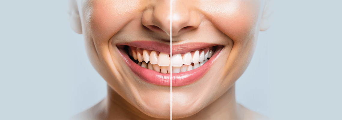 Role-Of-Teeth-Whitening-In-Smile-Makeovers-A-Detailed-Guide
