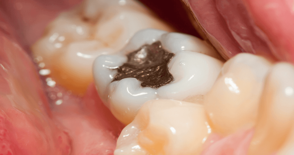 Amalgam filling removal