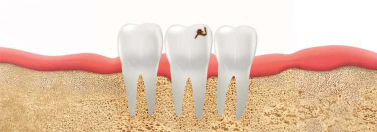 Symptoms of a Tooth Cavity