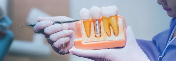Choosing the Right Dental Implants