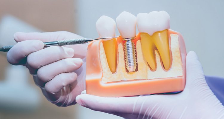 Choosing the Right Dental Implants