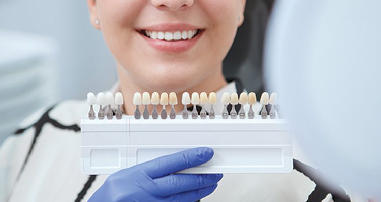 Tooth Coloured Fillings