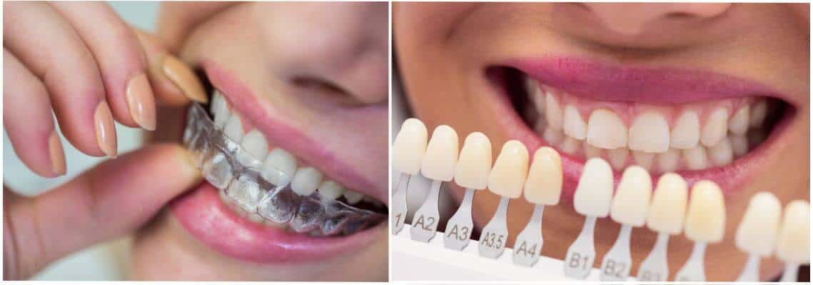 Veneers Vs. Clear Aligners: Which Treatment Option Is Right For You? 1 Veneers Vs Clear Aligners