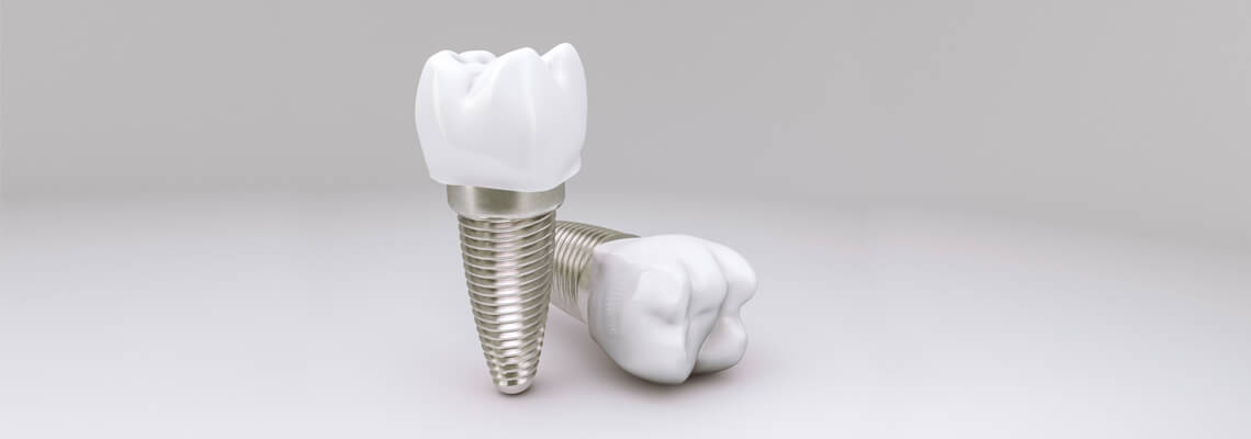 What Are Dental Implants