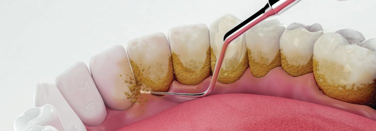 Plaque buildup on teeth