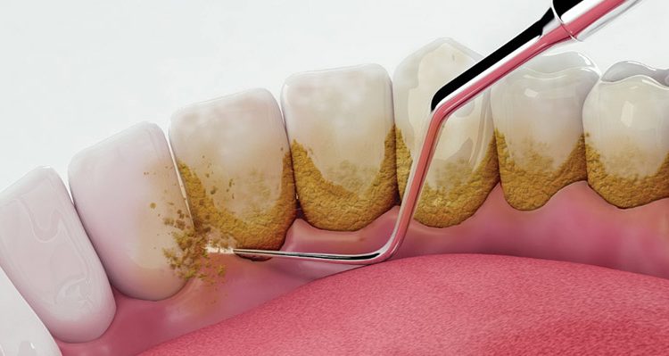 Plaque buildup on teeth