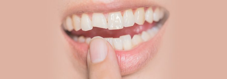 Patient with Chipped Tooth Seeking Dentist