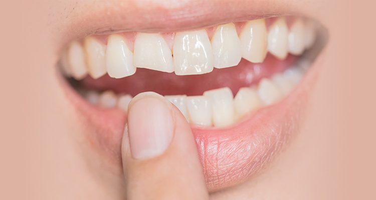 Patient with Chipped Tooth Seeking Dentist