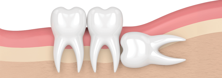 Wisdom Teeth Removal