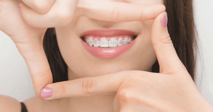 Adult braces
