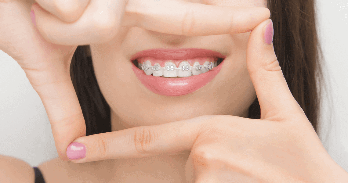 Adult braces