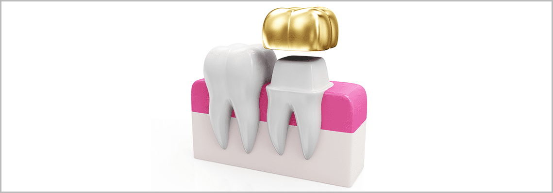 Dental Crowns: Types, Procedure Overview, and Costs