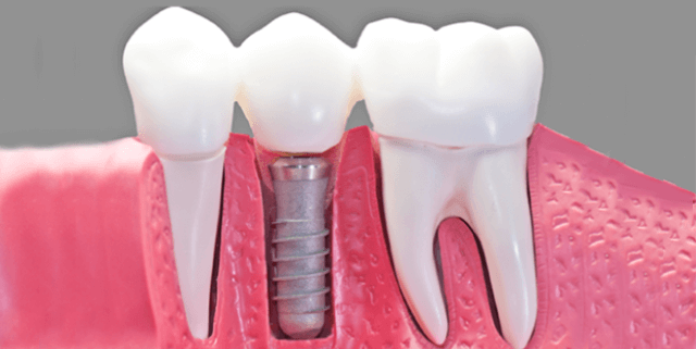 dental implant